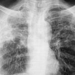 Roraima tem a maior incidência de tuberculose do Brasil, aponta levantamento