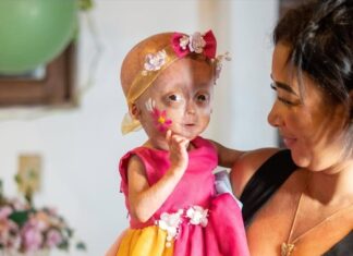 Elis, uma das gêmeas de RR com síndrome de envelhecimento precoce, morre aos 5 anos Elis, uma das gêmeas de RR com síndrome de envelhecimento precoce, morre aos 5 anos