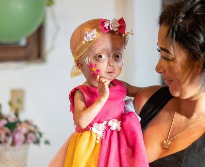 Elis, uma das gêmeas de RR com síndrome de envelhecimento precoce, morre aos 5 anos