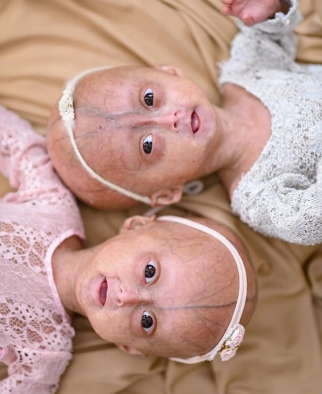 Elis, uma das gêmeas de RR com síndrome de envelhecimento precoce, morre aos 5 anos